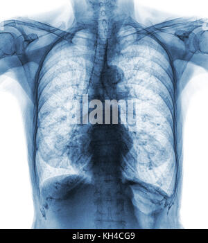 Radiografia toracica normale di un paziente anziano . Si può vedere calcificazione a costola , trachea , bronco . Vista frontale . Foto Stock