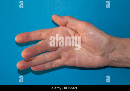 Dupuytren contrattura della deformità: una cordicella nel palmo della mano (con un nodulo duro alla base del dito medio) tira il dito in posizione piegata. Foto Stock