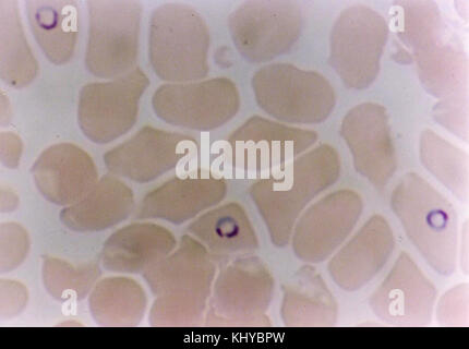 Questa illustrazione scientifica o immagine mostra il Plasmodium falciparum, un parassita responsabile della malaria, all'interno dei globuli rossi umani. Evidenzia l'interazione biologica tra il parassita e le cellule ospiti. Foto Stock