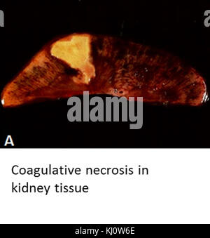 Coagulanti necrosi nel tessuto renale Foto Stock