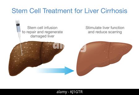 Cirrosi epatica il trattamento con cellule staminali. Illustrazione Vettoriale