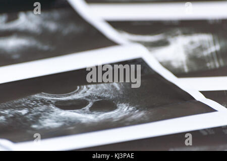 Scatti fotografici di ultra sound studio di foliculometry nel protocollo del programma ecologico nel processo di stimolazione ormonale. ivf Foto Stock