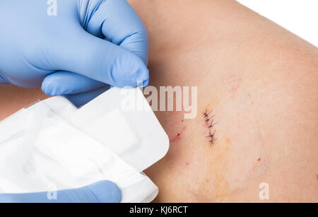 Medico mani patching chirurgia cucita con nuovo bendaggio sterile dopo la rimozione dello stampo procedura Foto Stock