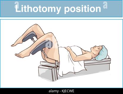 Posizione di litotomia Illustrazione Vettoriale