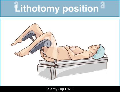 Posizione di litotomia Illustrazione Vettoriale