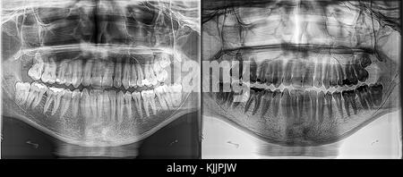 Panoramica di xray dentale, denti fissi, amalgama dentale guarnizione, saggezza denti interessati verticalmente, cisti nella cavità nasale Foto Stock