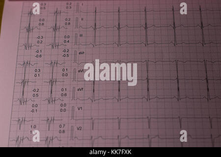 Un electrokardiogram foglio di stampa su un ufficio medici close up Foto Stock