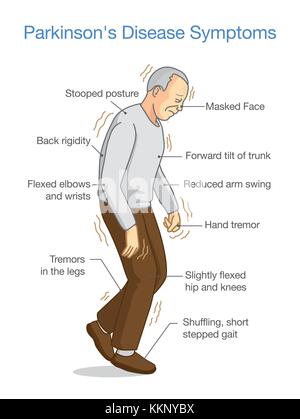 Illustrazione sui sintomi del morbo di Parkinson e segno. Illustrazione Vettoriale