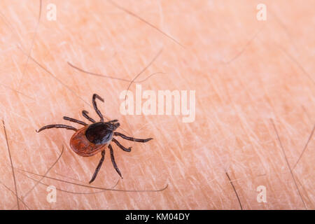 Dettaglio di deer tick sulla pelle umana. Ixodes ricinus. Parassiti pericolosi. Vettore di infezione come encefalite e borelliosi di Lyme. Fastidioso insetto. Foto Stock