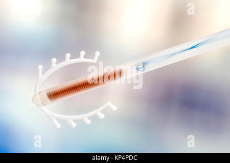 IUD Foto Stock