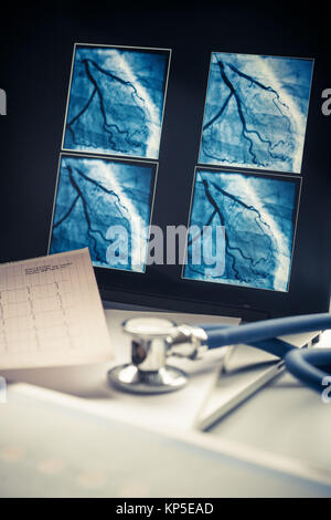 La telemedicina, qui angiogramma coronarico arteria affetta da stenosi. Foto Stock