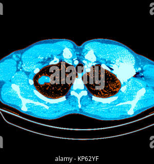 CTscan colorati della parte superiore del torace che mostra un tumore del polmone. Foto Stock