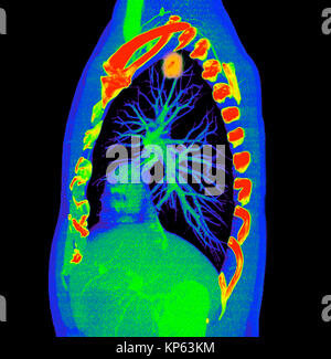 CTscan colorati della parte superiore del torace che mostra un tumore del polmone. Foto Stock