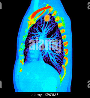 CTscan colorati della parte superiore del torace che mostra un tumore del polmone. Foto Stock