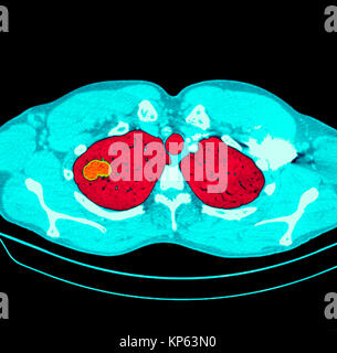 CTscan colorati della parte superiore del torace che mostra un tumore del polmone. Foto Stock