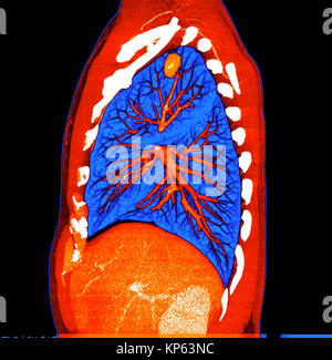 CTscan colorati della parte superiore del torace che mostra un tumore del polmone. Foto Stock