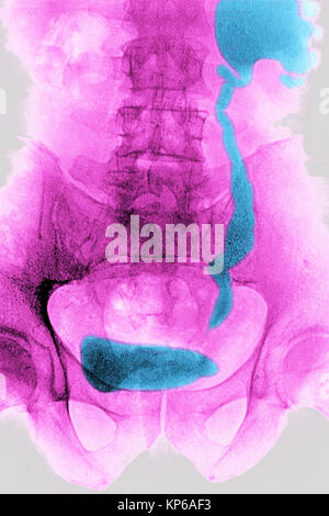 NEPHRITIC colica, RAGGI X Foto Stock