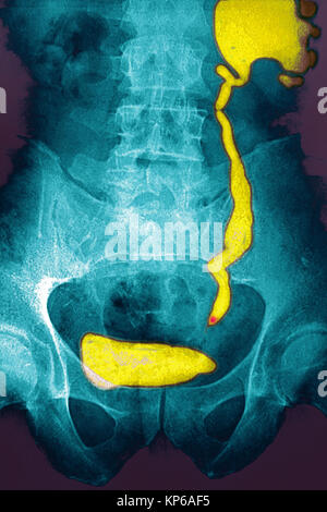 NEPHRITIC colica, RAGGI X Foto Stock