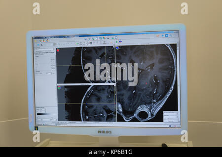 Profonda stimolazione cerebrale Foto Stock