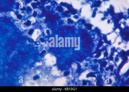 Tale micrografia mostra variazioni istopatologiche dovuta a batteri gram-positivi organismo, Actinomyces israelii, 1971. Utilizzando una modificata Fite-Faraco macchia, un ?. granulo di zolfo?. è mostrata al centro dell'immagine. Questi granuli costituiscono in realtà delle colonie di A. israelii, gram-positivi, anaerobico batteri filamentosi. Immagine cortesia CDC/Dott. Lucille Georg. Foto Stock