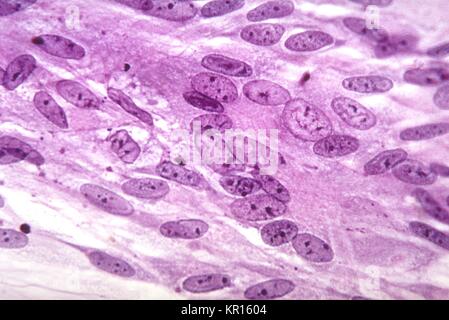 Questo fotomicrografia rivela le inclusioni intranucleare prodotta da varicella virus cresciuto in una coltura di tessuto, ingrandito 500X, 1964. In un contesto di laboratorio, si può osservare la presenza di multinucleated cellule giganti lungo con inclusioni intranucleare in colture cellulari inoculate con il virus della varicella. Immagine cortesia CDC. Foto Stock