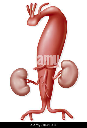 Aneurisma aortico Foto Stock