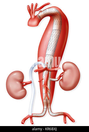 Trattamento dell'aneurisma Foto Stock