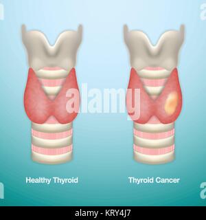 Tiroide sani e cancro alla tiroide. EPS10 illustrazione vettoriale. Illustrazione Vettoriale