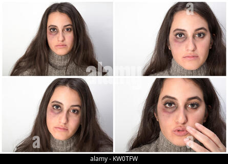 Quattro ritratti di un abusato della donna con un nero schiacciato occhio guardando la telecamera con un grave triste espressione in un concetto di violenza domestica Foto Stock