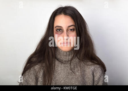 Abusato della donna con un ferito occhio nero vittima di violenza domestica in posa contro un bianco di sfondo per studio fissando in telecamera Foto Stock