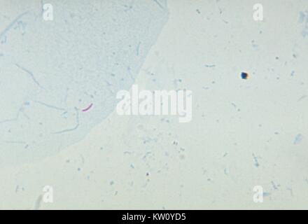 Una microfotografia di Mycobacterium tuberculosis in uno striscio di espettorato, utilizzando acido Ziehl-Neelsen-fast tecnica della macchia. Infezione è trasmessa da una persona ad un altro quando una persona infetta tossisce o starnutisce, e in tal modo il rilascio di batteri-contenente microgocce in aria per essere inalato da un destinatario non infette, che poi diventa infetto. Immagine cortesia CDC/Ronald W. Smithwick, 1971. Foto Stock