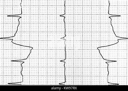 Elettrocardiogramma test che mostra attività elettrica del cuore Foto Stock