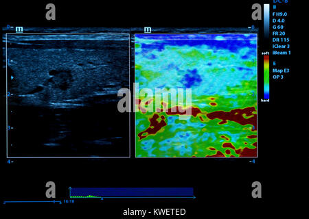 Immagine colorata dei moderni monitor ad ultrasuoni. Ecografia macchina. Alta tecnologia medica e attrezzature sanitarie. Imaging a ultrasuoni o sonogra Foto Stock