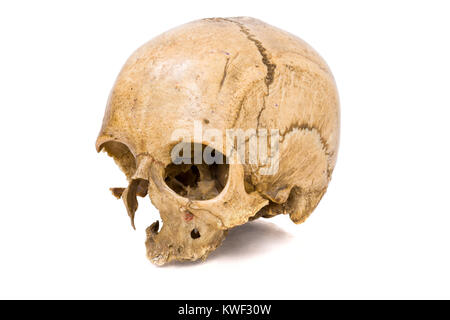 Un vecchio jawless Scull umano isolato su bianco Foto Stock