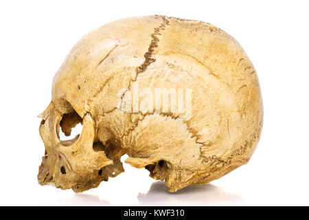 Un vecchio jawless Scull umano isolato su bianco Foto Stock