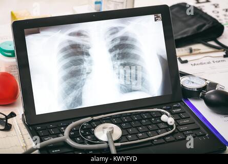 Petto x ray su uno schermo del computer su una scrivania Foto Stock