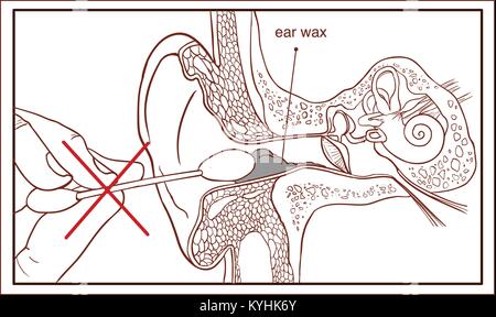 La sezione dell'orecchio con il cerume - schema colorato Illustrazione Vettoriale