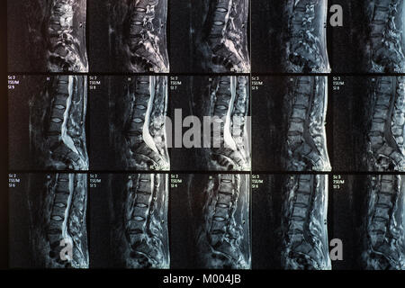 Immagini a risonanza magnetica della colonna vertebrale umana con lordosi, ernia discale e spondylolisthesis l5-s1 Foto Stock