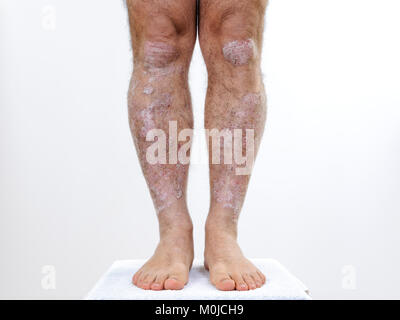 In prossimità della parte anteriore delle gambe di una persona affetta da psoriasi cronica, su uno sfondo bianco. Foto Stock