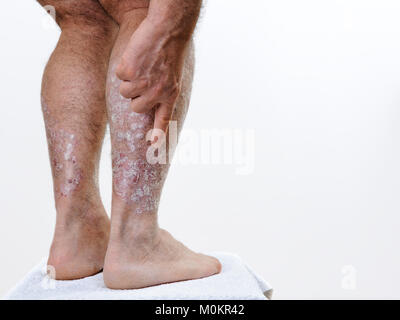 Chiusura del retro delle gambe di una persona affetta da psoriasi cronica, su uno sfondo bianco. Foto Stock