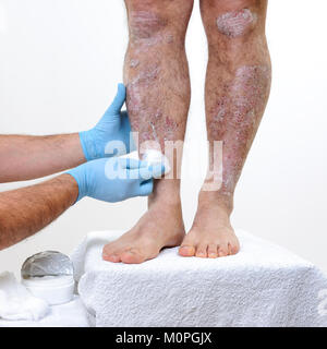 Il dermatologo con le mani protette da guanti tratta con la crema della infiammazione delle gambe di un uomo adulto affetti da psoriasi Foto Stock