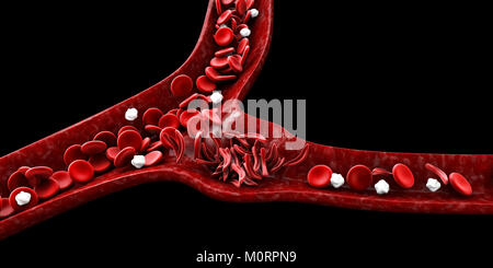 Anemia falciforme, 3D illustrazione che mostra il vaso sanguigno con il normale e deformato crescent Foto Stock