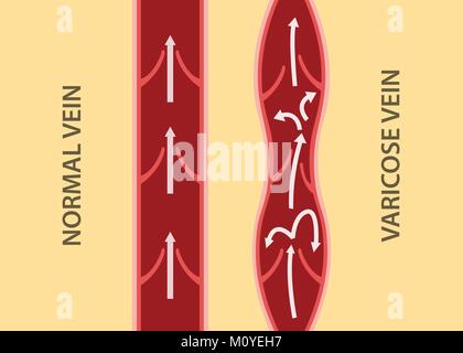 Confronto confronta tra normale e Vena vena varicosa in allineamento verticale Illustrazione Vettoriale