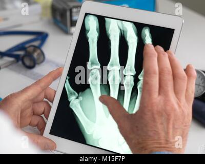 Modello rilasciato. Medico la visione a raggi X di una mano su di una tavoletta digitale. Foto Stock