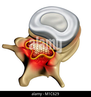 La stenosi spinale come una malattia degenerativa nelle vertebre umane causando la colonna vertebrale compressa nervi concetto medico come 3D'illustrazione. Foto Stock