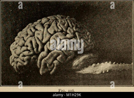 Un trattato sulle malattie del sistema nervoso dei bambini, per i medici e gli studenti (1905) (14761683066) Foto Stock