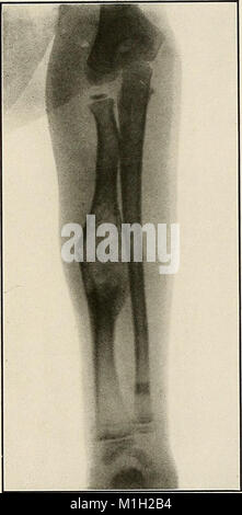 Un atlante radiografico delle variazioni patologiche delle ossa e articolazioni (1911) (14757925152) Foto Stock