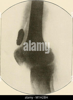 Un atlante radiografico delle variazioni patologiche delle ossa e articolazioni (1911) (14735228756) Foto Stock