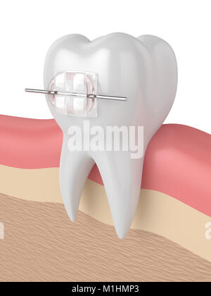 3D render del dente con ceramica chiara tutore di gengive Foto Stock