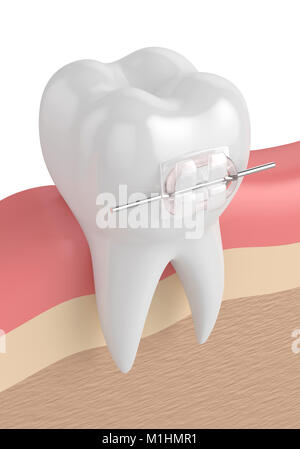 3D render del dente con ceramica chiara tutore di gengive Foto Stock